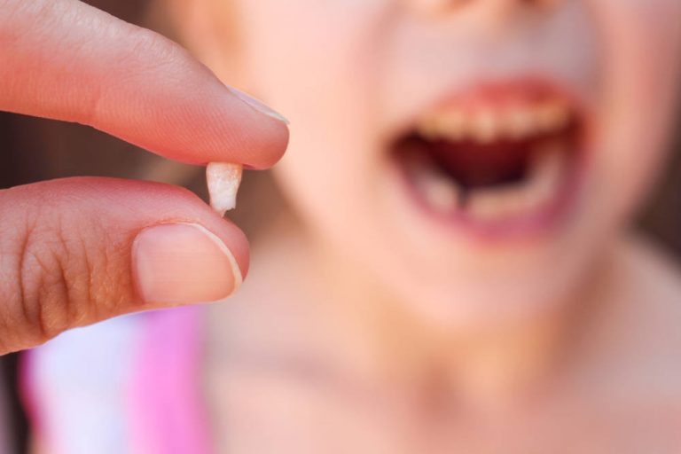 Consulta a los expertos: ¿Qué hacer si a tu hijo se le rompe un diente?